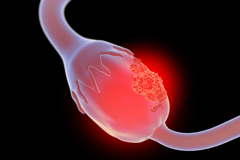 Depiction of an ovary with cancer cells.