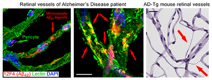 Figure 4. Retinal vasculopathy in Alzheimer's disease. From Koronyo-Hamaoui Lab: Left image: Shi, et al., Acta Neuropathologica. 2020. Right image: Shi, et al., ANP Commun. 2020.