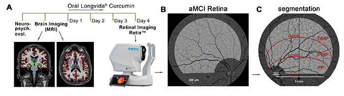 Figure 8. Retinal amyloid imaging in MCI and AD patients was developed by the Koronyo-Hamaoui Lab and NeuroVision Imaging. Adopted from: Dumitrascu, et al., Alzheimer & Demen. (Amst.) 2020.