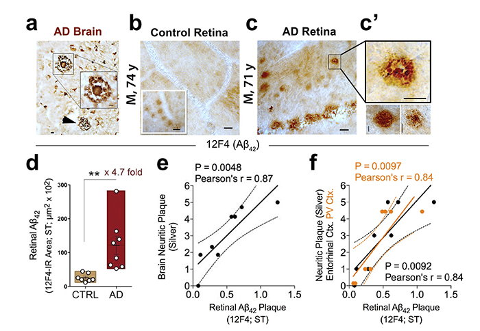 Figure 1. Retinal amyloid pathology in AD patients. Increased retinal Aβ42 deposition correlates with cerebral amyloid plaque burden in Alzheimer’s patients. From the Koronyo-Hamaoui Lab: Koronyo, et al., JCI Insight. 2017.