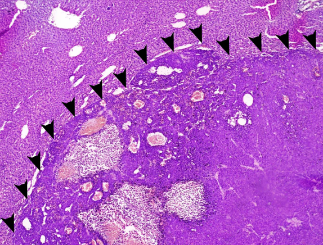 Graphic of Liver Metastasis Project 1