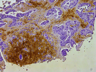 Graphic of Liver Metastasis Project 2