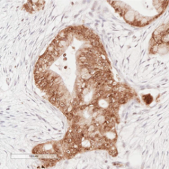 Graphic of Liver Metastasis Project 3