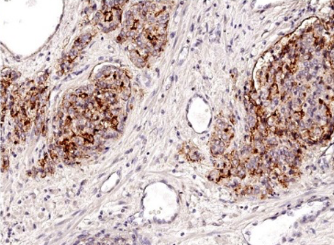 Graphic of Liver Metastasis Project 4