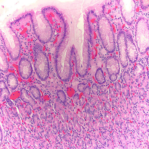 Pathology, Cedars-Sinai, Cancer, Signet ring gastric adenocarcinoma, diffuse type