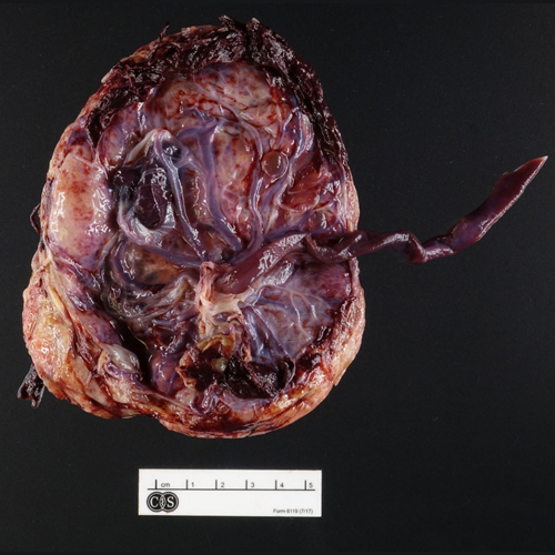 Gross Photo, fetal Surface, Cedars-Sinai, pathology