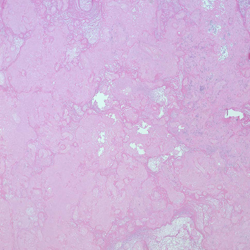 massive fibrin deposition, Cedars-Sinai, pathology