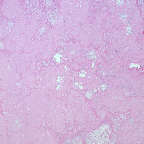 massive fibrin deposition, Cedars-Sinai, pathology