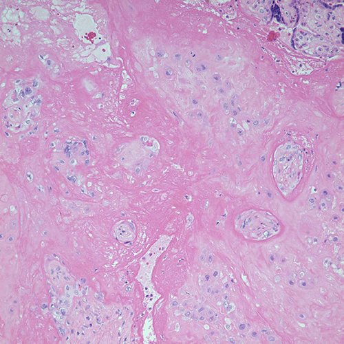 Chorionic villi, atrophic, Cedars-Sinai, pathology
