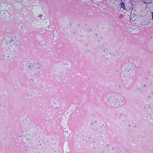 Chorionic villi, atrophic, Cedars-Sinai, pathology