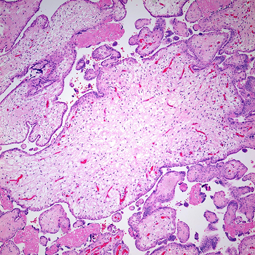 H&E, 10x. Markedly enlarged villus with myxoid stroma.