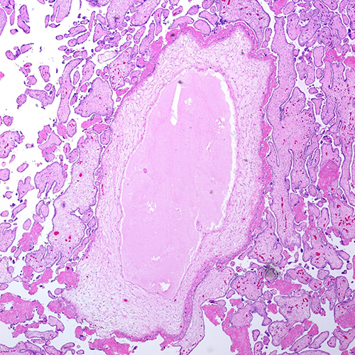 H&E, 4x. Section corresponding to grape-like cyst seen grossly showing a markedly enlarged villus with a massive, cavernous cystic structure with surrounding myxoid stroma.