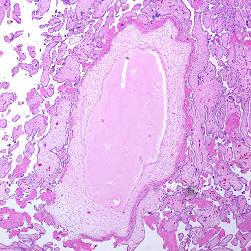 H&E, 4x. Section corresponding to grape-like cyst seen grossly showing a markedly enlarged villus with a massive, cavernous cystic structure with surrounding myxoid stroma.