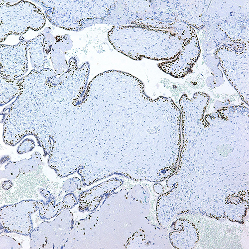Immunohistochemical stain for p57, 10x. Immunostain highlights the cytotrophoblastic cells located at the periphery of the abnormally large villi; the remaining stromal cells within the villi are completely negative.