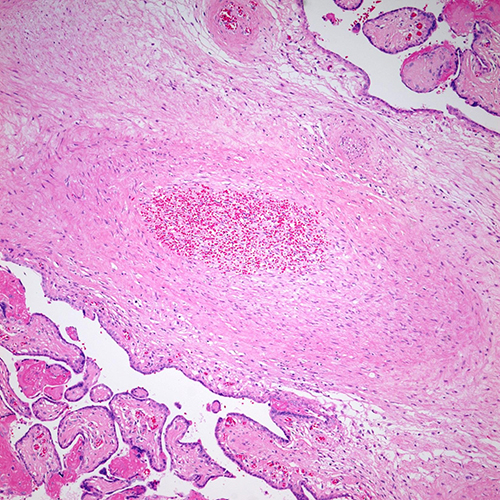 H&E, 10x. Stem villus vessel showing luminal obliteration and associated fibrointimal proliferation, consistent with late stages of thrombosis.
