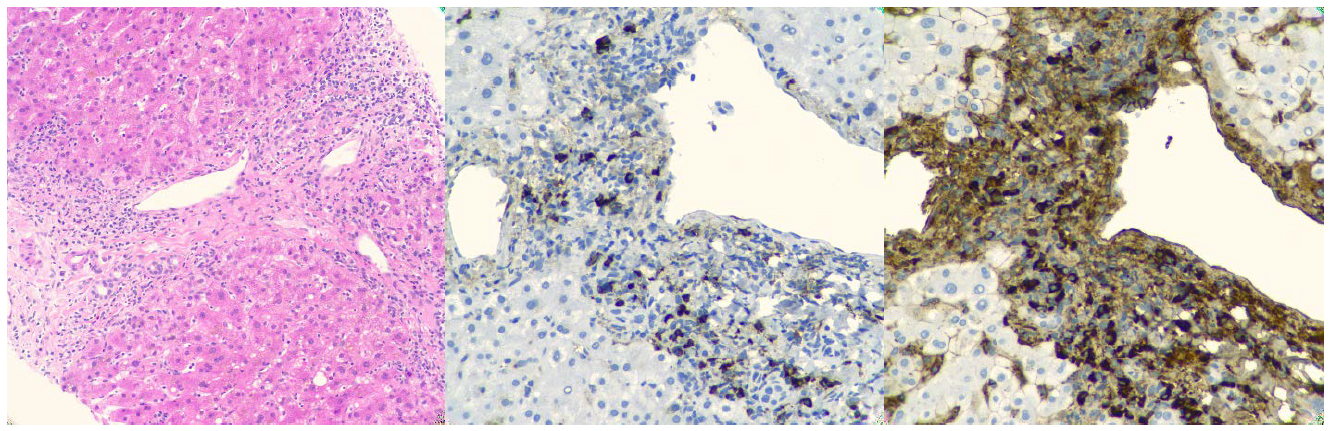 pathology, Cedars-Sinai, case of the month, january, 2020, IgG4-positive plasma cells