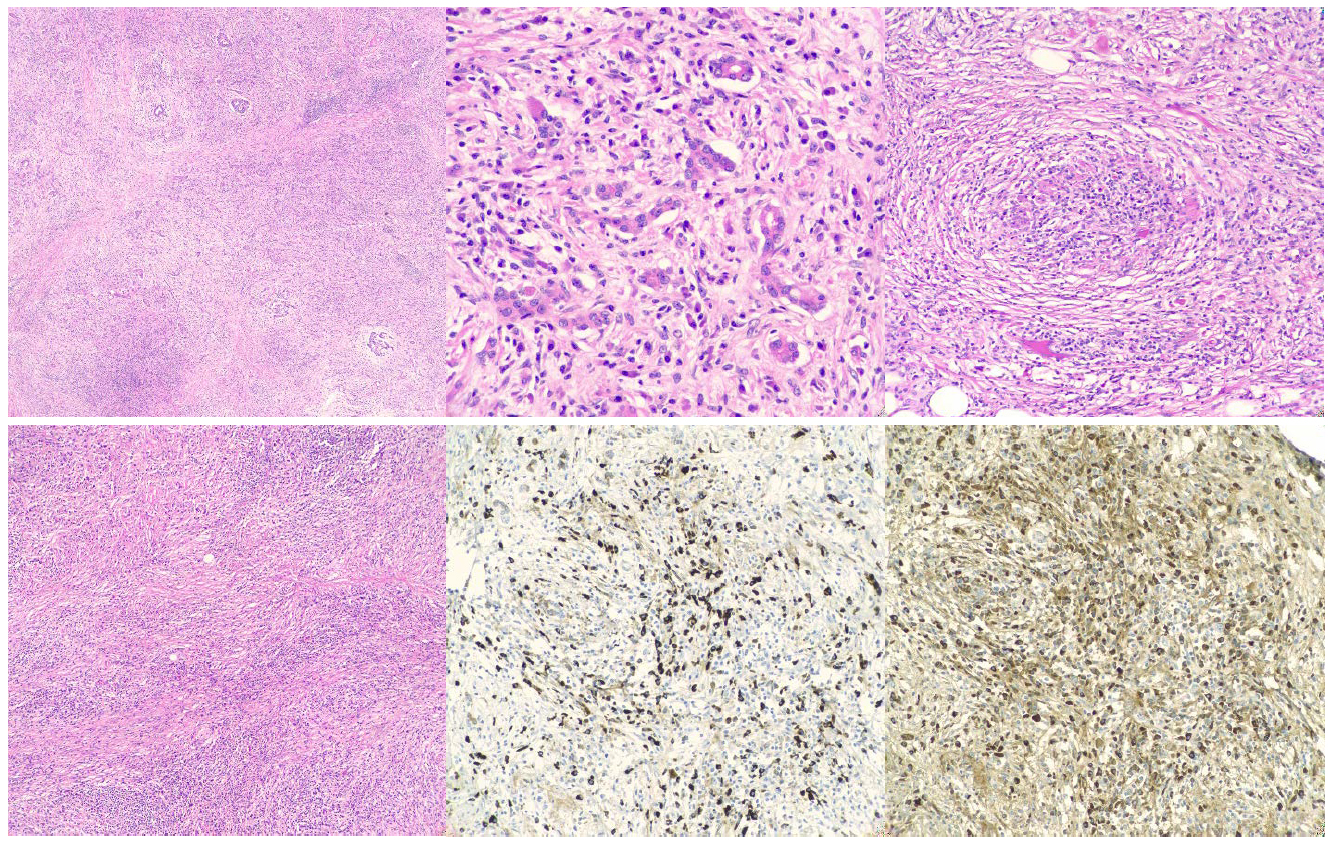 pathology, Cedars-Sinai, case of the month, january, 2020, pancreatectomy specimen
