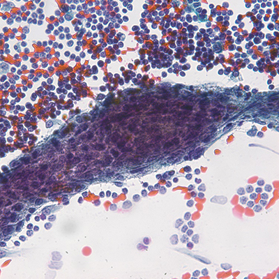 Direct smears showing bland epithelioid to spindled cell proliferation in a lymphocytic background