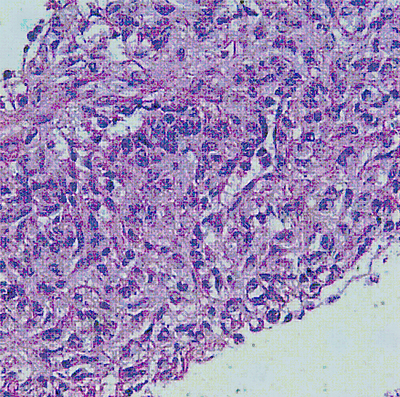 cell block showing bland epithelioid to spindled cell proliferation with few vessels seen