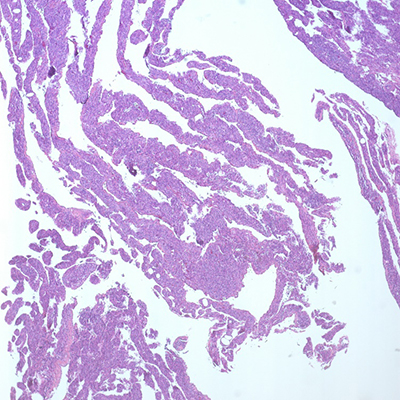 Spindled cell proliferation in cystic spaces, H&E, 4x