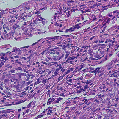 Spindled cells surrounding multiple vessels, H&E, 60x