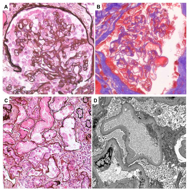 Cedars-Sinai, case of the month, Pathology, May, Renal Pathology