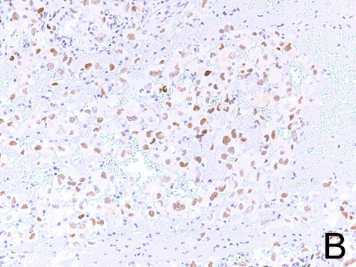 Positive nuclear staining for cMYC.