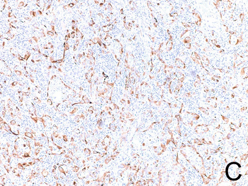 Positive cytoplasmic staining for cytokeratin (OSCAR) in tumor cells.