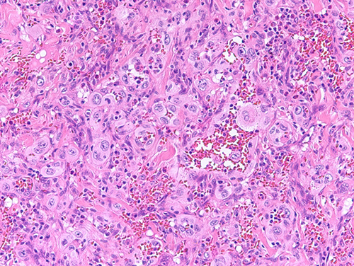 Section of small intestine tumor showing a predominately solid proliferation of large round to polygonal epithelioid cells with abundant eosinophilic cytoplasm, vesicular nuclei, central nucleoli, and frequent mitoses.