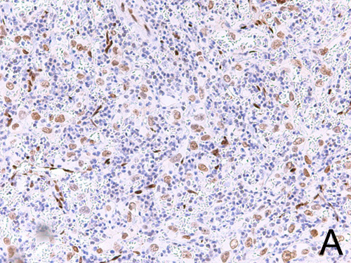 The tumor shows positive nuclear staining for the endothelial marker, ERG.