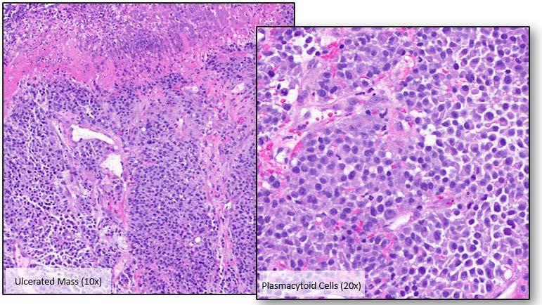 Figure 1: The mass consisted of sheets of pleomorphic plasmacytoid cells with evident mitotic activity.