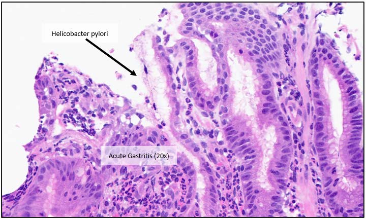 Figure 2: Background Gastritis