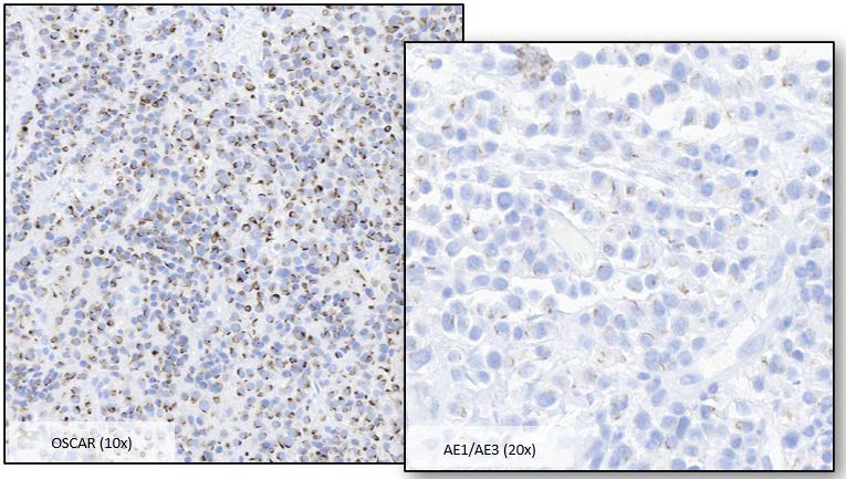 Figure 3: Pancytokeratin Expression