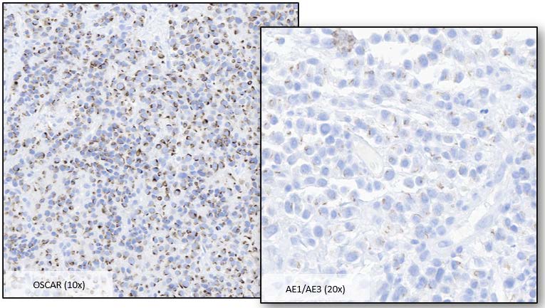 Figure 3: Pancytokeratin Expression