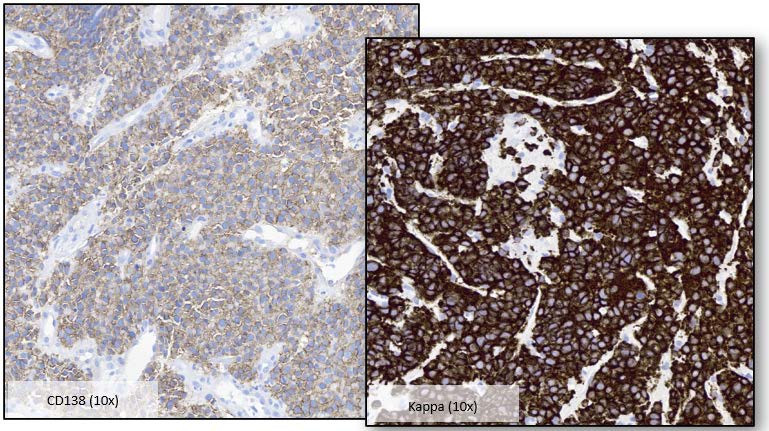 Figure 4: CD138 and Kappa Expression