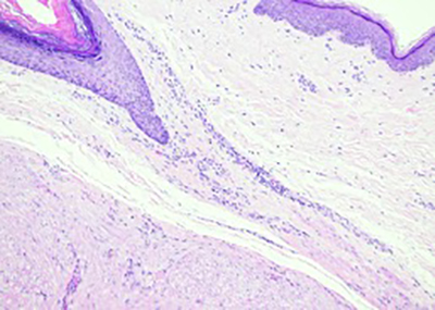 Cutaneous leiomyoma originating from an arrector pili muscles (100x)