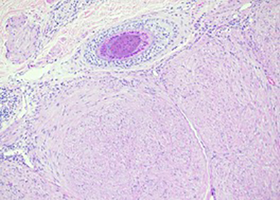 Cutaneous leiomyoma originating from an arrector pili muscles (200x)