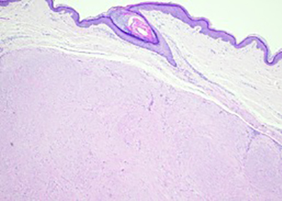 Cutaneous leiomyoma originating from an arrector pili muscles (40x)