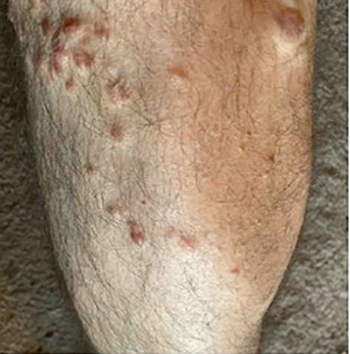 Multiple firm, red or reddish-brown cutaneous nodules on a leg.