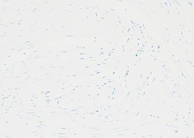 Loss of fumarate hydratase, patient (400x)