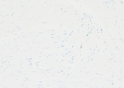 Loss of fumarate hydratase, patient (400x)