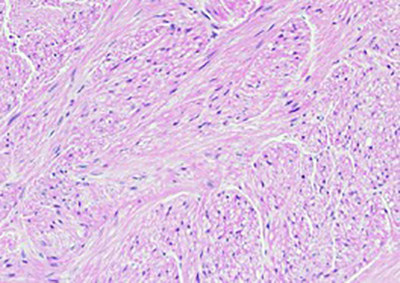 Smooth muscle bundles, with bland, blunt ended spindle cell nuclei (400x)