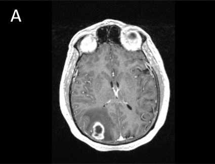 Figure A. T1-post contrast MRI showing a right parietal, rim-enhancing lesion.