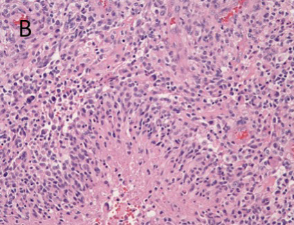 Figure B. H&E of the tumor showing endothelial proliferation with palisading necrosis