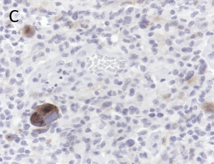 Figure C. ALK positively in ~5% of tumor cells.