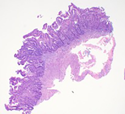 Adenocarcinoma embedded in endometrial stroma at 100x.