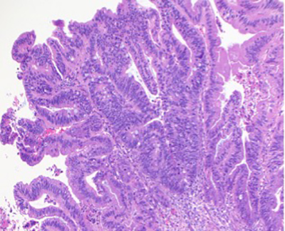 Adenocarcinoma embedded in endometrial stroma at 400X