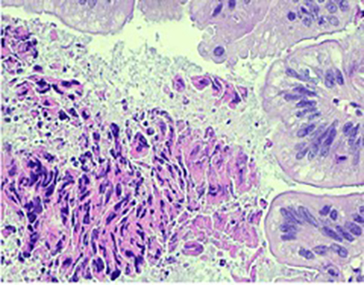 Adenocarcinoma with dirty necrosis