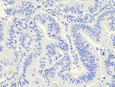The malignant cells are negative for CK-7