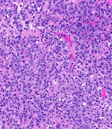 B-cell lymphoma